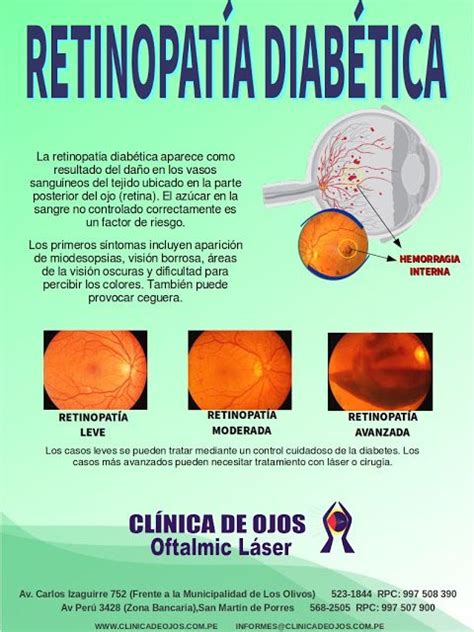 Clínica de Ojos Oftalmic Láser RETINOPATÍA DIABÉTICA Anatomía del