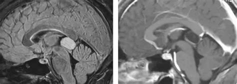 脑室内肿瘤手术策略与技巧 The Neurosurgical Atlas全文翻译 脑医汇 神外资讯 神介资讯