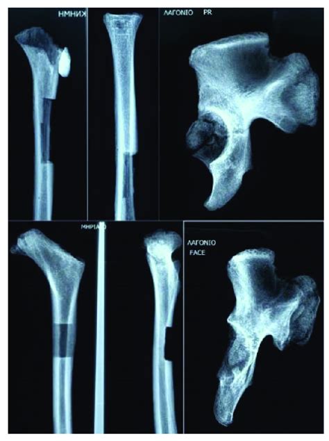 X-ray of the long and pelvic bones. | Download Scientific Diagram