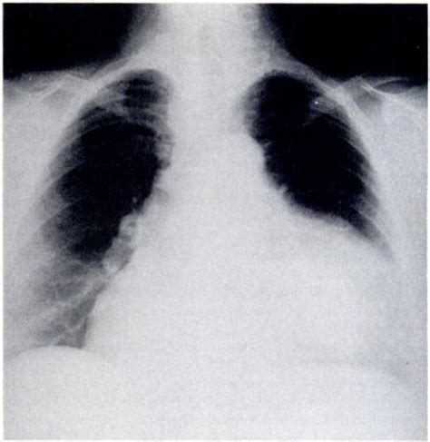 Chest Roentgenogram Of Showing Large Mediastinal Mass With