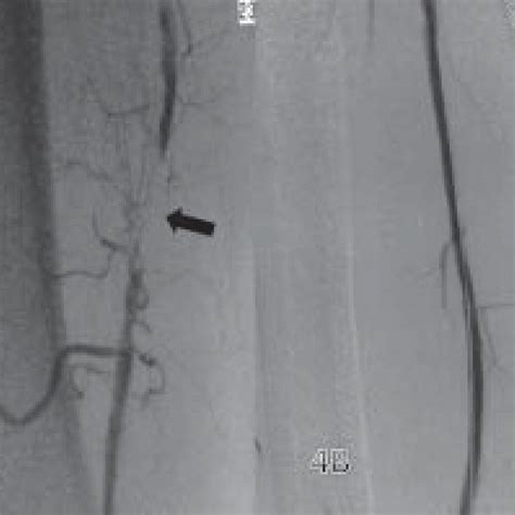 A B Superfi Cial Femoral Artery Sfa Stenosis Preintervention Download Scientific Diagram