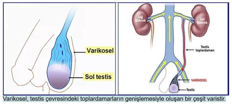 Varicose Veins Testicles