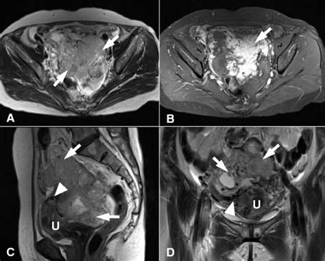 Pelvic Magnetic Resonance Image Of The Pedunculated Subserosal