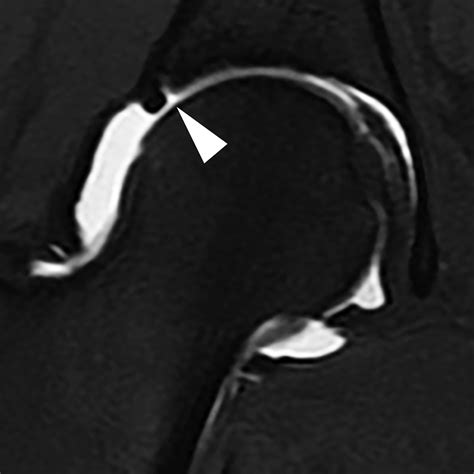 Mr Imaging Of The Hip Avoiding Pitfalls Identifying Normal Variants Applied Radiology