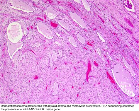 Pathology Outlines Dermatofibrosarcoma Protuberans Dfsp