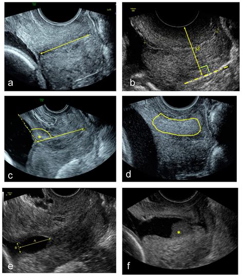 Example Images Of A Transvaginal Ultrasound Cervical Length