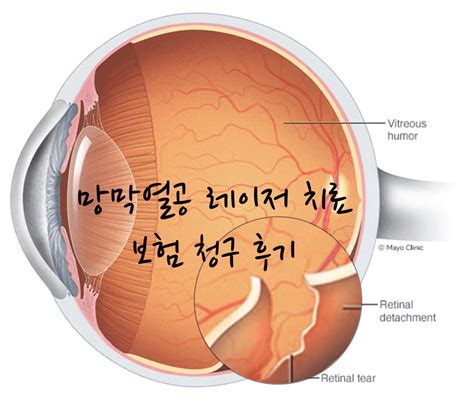 망막열공 레이저 치료 보험 청구 후기