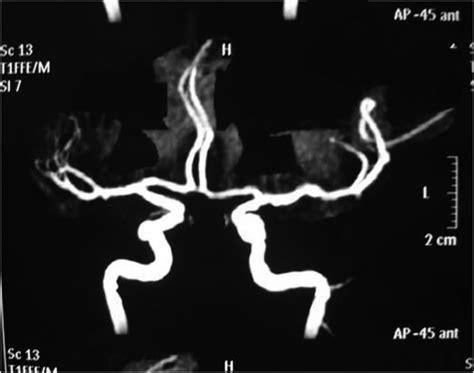 Brain MRI Angiography. Normal. | Download Scientific Diagram