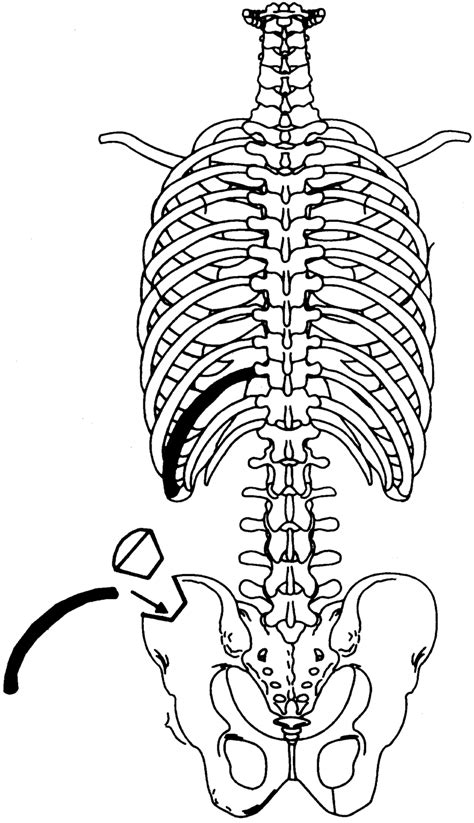 Illustration Of The Use Of A Rib For The Reconstruction Of Iliac Crest Download Scientific