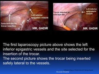 inferior epigastrik arter laparoskopisi