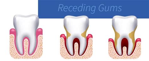 What Causes Receding Gums?