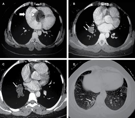 A High Resolution Ct Of The Lung With Iv Contrast Shows A Round Download Scientific Diagram