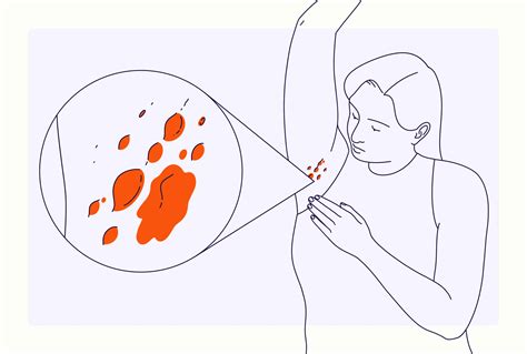 Hidradenitis Suppurativa (HS): Symptoms and Pictures