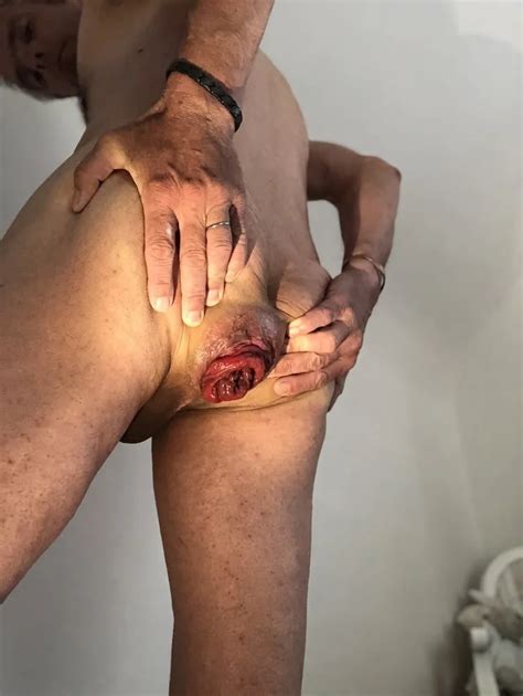 Dilatation Prolapse Anal 9 Pics XHamster