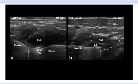 Figure From Retroclavicular Vs Supraclavicular Brachial Plexus Block