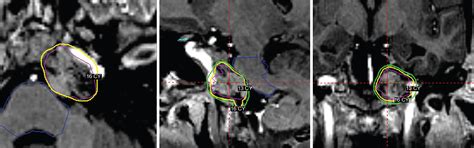 Chondrosarcoma – definitive radiosurgery after subtotal resections ...