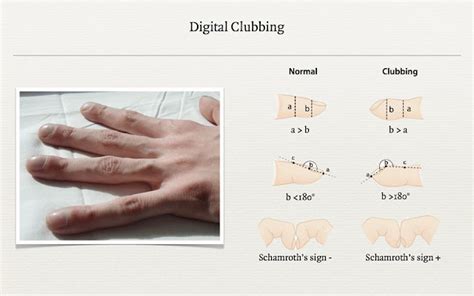 Nauts Medical Tips Clubbing Of Fingers