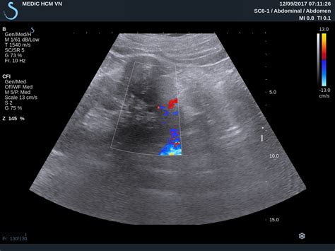 VIETNAMESE MEDIC ULTRASOUND: CASE 457: AML KIDNEY TUMOR, Dr PHAN THANH ...