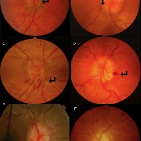 Surface And Buried Optic Nerve Head Drusen The Disc Is Elevated And