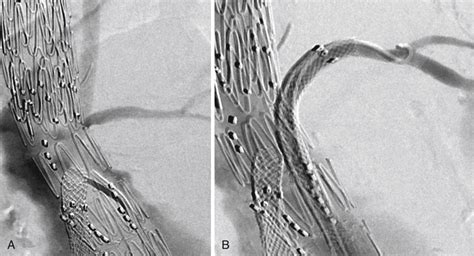 Operative Thrombectomy For Acute Thrombosis Of Lower Extremity Bypass Grafts Thoracic Key