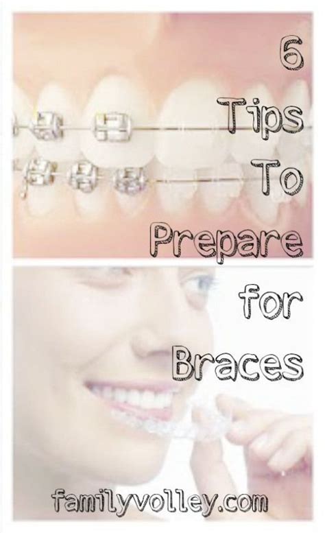 6 Tips to Prepare for Braces by @familyvolley. #tweet #braces #teen # ...