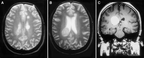 Axial T2 Weighted Brain Mri Image Tr 2314 Ms Te 90 Ms Reveals