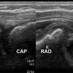 t shows the structures on the lateral aspect of the elbow (LCL-Lateral ...