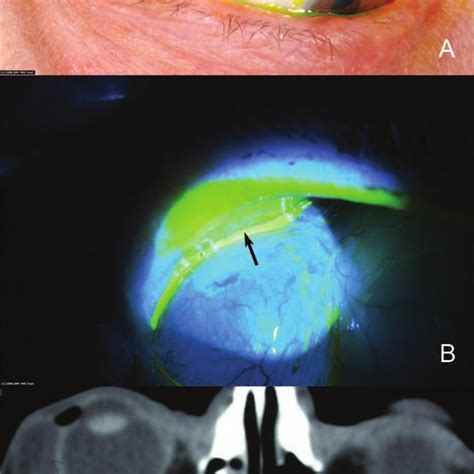 (PDF) Marsupialization for Lacrimal Ductular Cysts (Dacryops): A Case Series