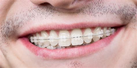 Brackets estéticos Tipos y beneficios