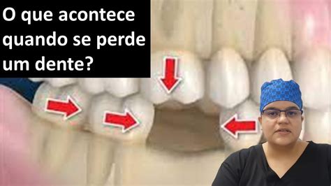 O Que Acontece Quando Se Perde Um Dente Dra Bianca Rosa Cl Nica