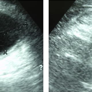 Abdominal Ultrasonography Showing An Oval Shaped Hypoechoic Lesion In