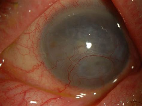 Corneal Disorders Hku E Learning Platform In Clinical Neurosciences