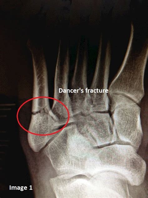 Treatment Options For 5th Metatarsal Fractures