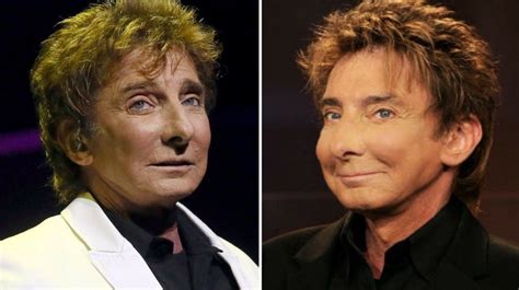 Barry Manilow Before And After Plastic Surgery Celebrity Plastic