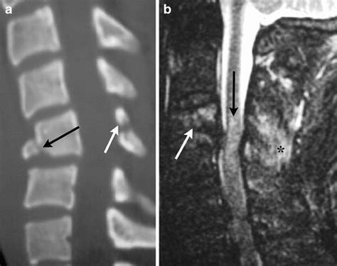 2 Flexion Teardrop Fracture A Sagittal Mdct Image Demonstrates