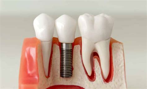 How Dental Implants Can Transform Your Life