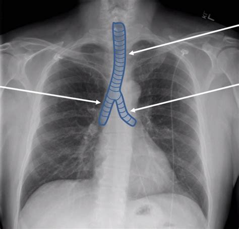 Radiology Chest X Rays Flashcards Quizlet