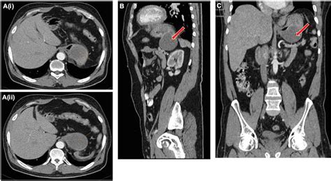 Adenocarcinoma Arising From A Gastric Duplication Cyst A Case Report