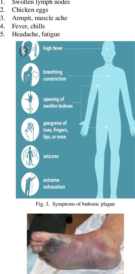 Bubonic Plague Symptoms Buboes