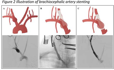 Hybrid Repair Of An Innominate Artery Pseudoaneurysm After Blunt