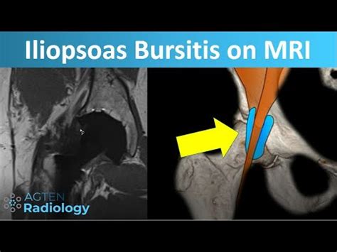 Hip Bursitis Iliopsoas