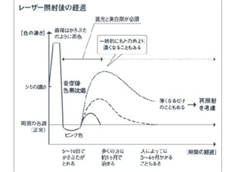 Qスイッチアレクサンドライトレーザー 千葉市若葉区都賀｜つが皮膚科医院