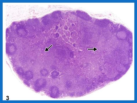 Histology And Pathology Of Lymph Nodes