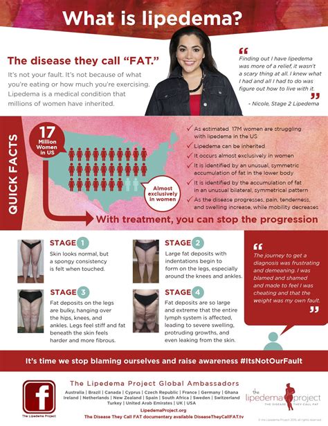 Lipedemainfographic 1nov2015 Lipedema Lipedema Treatment Lymphedema