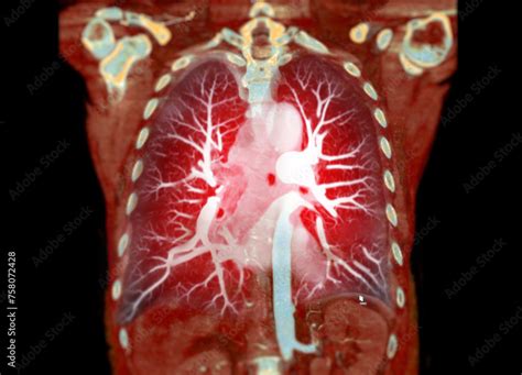 Cta Thoracic Aorta D Rendering Offers Detailed Visualization