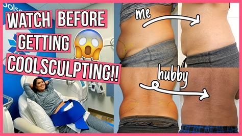 SHOCKING Coolsculpting Before After 6 Things You NEED To Know YouTube