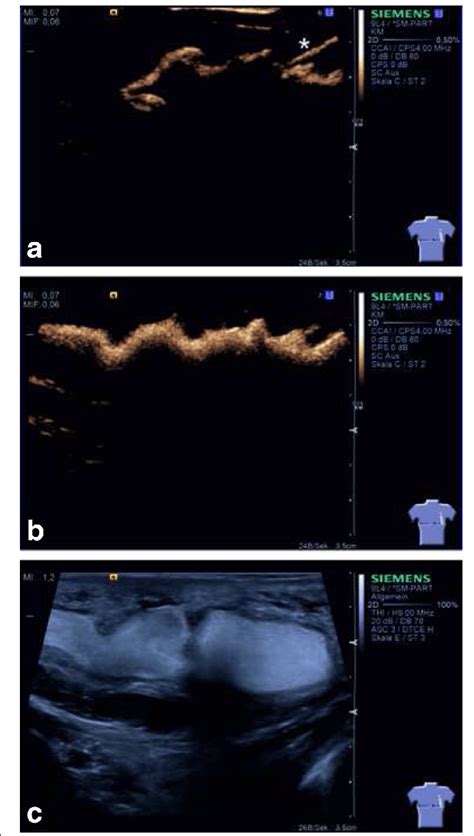 B Mode Contrast Agent Enhanced Ultrasound Of The Congenital Macrocystic