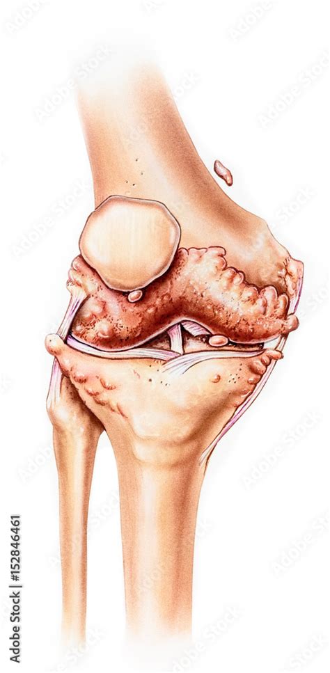 Osteophytes Knee