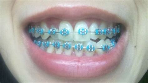 163 best Braces Colors images on Pinterest | Braces colors, Dental and ...