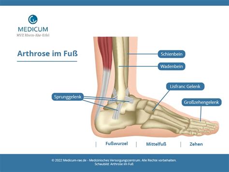 Arthrose Im Fu Symptome Behandlung Medicum Rhein Ahr Eifel